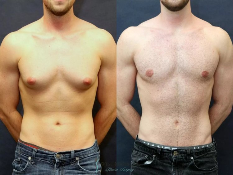 Best Gynecomastia Surgeons in Dubai: Qualifications and Experience to Look For