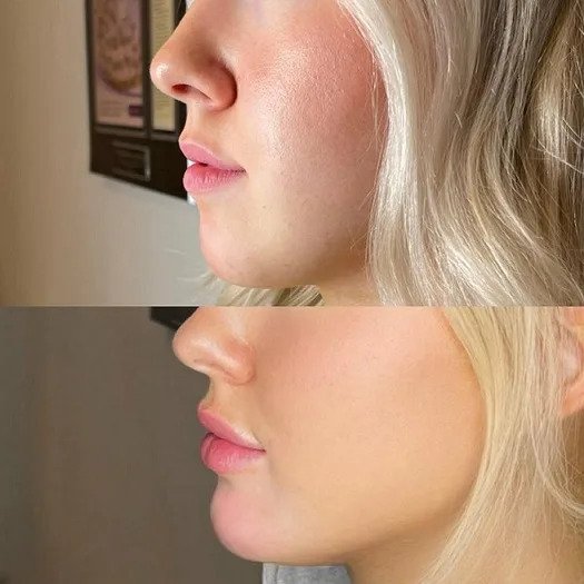 Achieve Harmony with Chin Fillers Treatment in Dubai