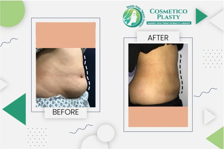 Liposuction Cost in Pakistan: Affordable Body Contouring Options for 2025