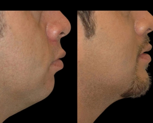 Double Chin Removal for a Youthful Jawline: Tips from the Best Doctors in Dubai